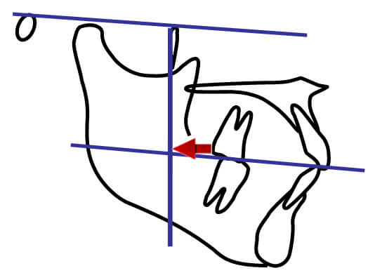 Figura 7 Distancia desde la cara distal del 1º molar superior hasta la vertical Pterigoidea. Fuente Propia