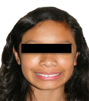 Fig. 1 Extraoral de frente de sonrisa