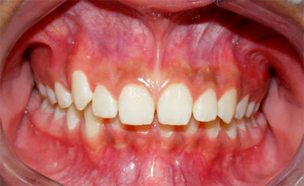 Fig. 3 Intraoral de frente