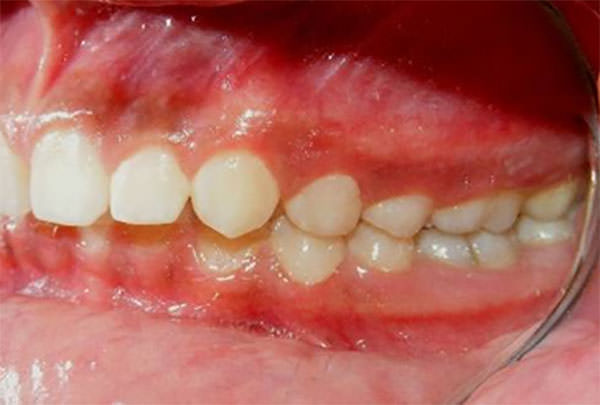 Fig. 5 Intraoral izquierda