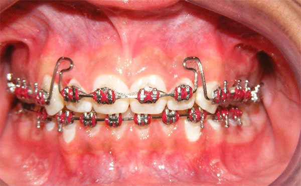 Fig. 8 Intraoral de frente