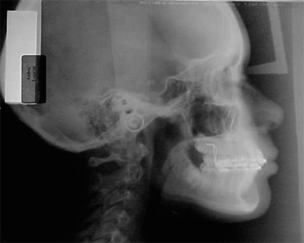 Fig. 10 Lateral de cráneo