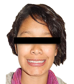 Fig. 10 Frente de sonrisa final