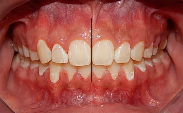 Fig. 12 Intraoral de frente final