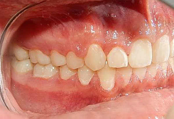 Fig. 13 Intraoral lateral derecha