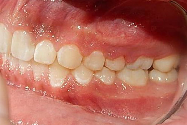 Fig.14 Intraoral lateral izquierda