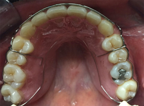 Fig. 16 Vista oclusal circunferencial