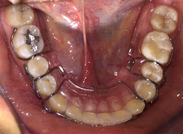 Fig. 17 Oclusal inferior retenedor Hawley