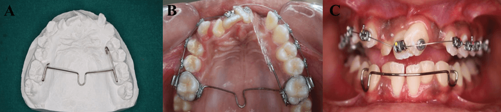 Figure 4:A.Fabricated modified TPA,B.Placement of modified TPA,C.Removable posterior bite plane.