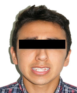 Fig. 1 Extraoral de frente sonrisa