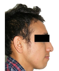 Fig. 2 Extraoral de perfil
