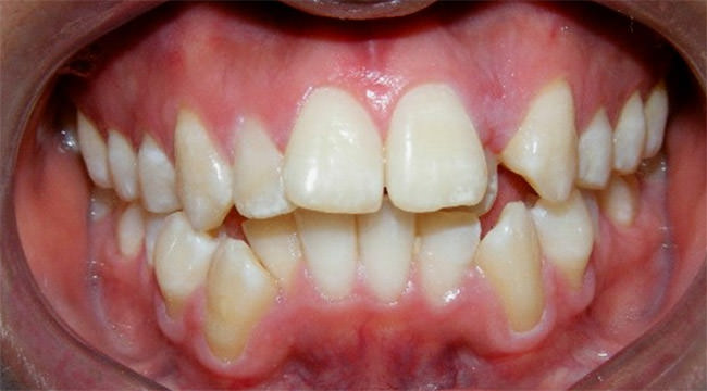Fig. 3 Intraoral de frente sonrisa