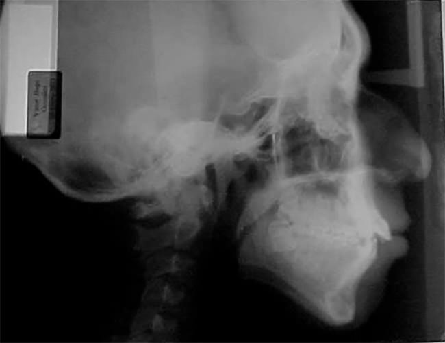 Fig. 6 Lateral de cráneo inicio