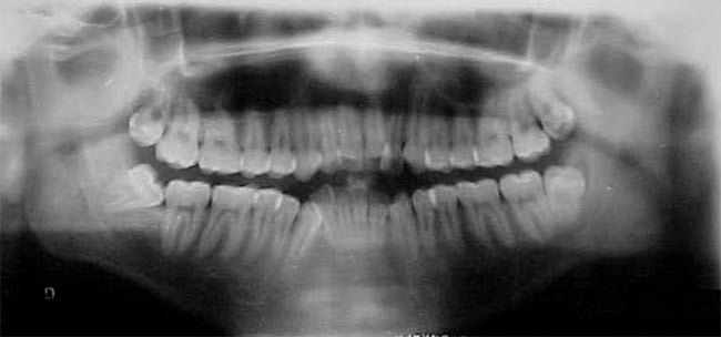Fig. 7 Radiografía panorámica