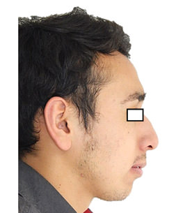 Fig. 8 Extraoral de perfil