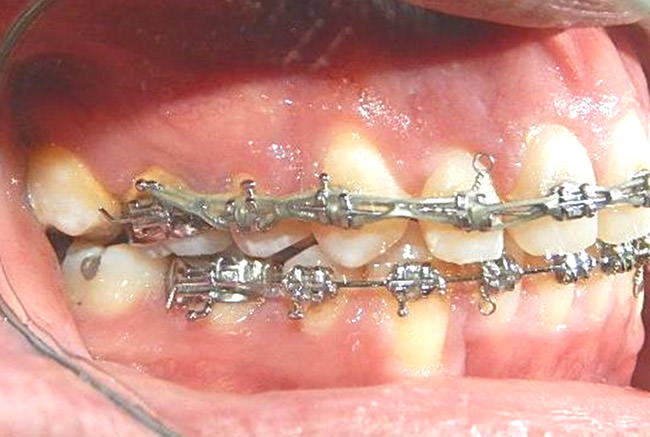Fig. 9 Intraoral lateral derecha