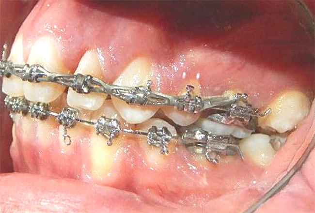 Fig. 10 Lateral izquierda