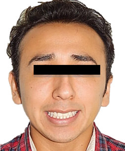 Fig.12 Extraoral comparativa inicio final sonrisa