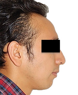 Fig.13 Extraoral perfil