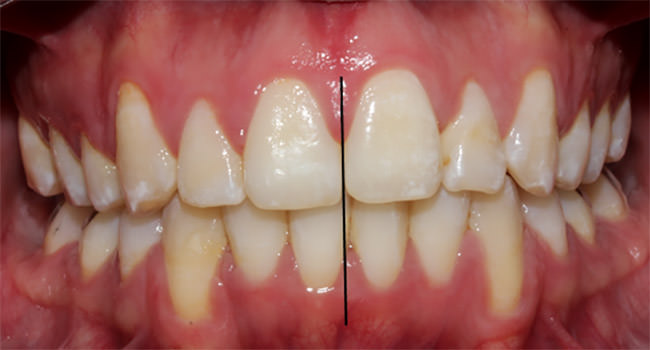 Fig.14 Intraoral frente
