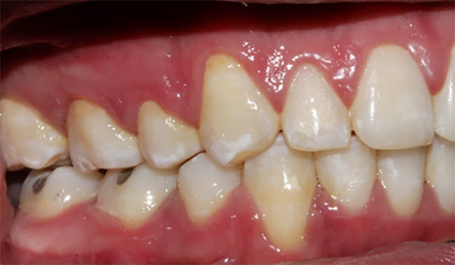 Fig.15 Lateral derecha