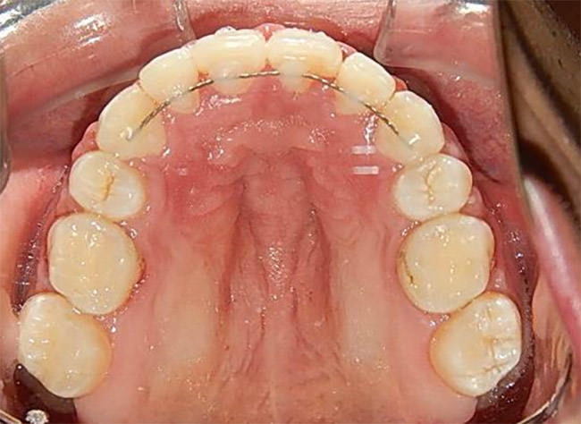 Fig.17 Intraoral oclusal superior