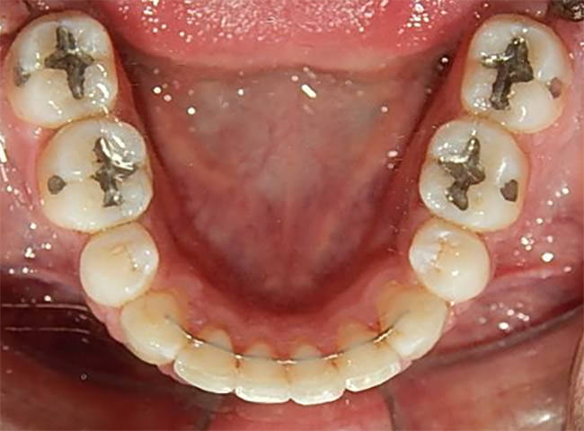 Fig.18 Intraoral oclusal inferior