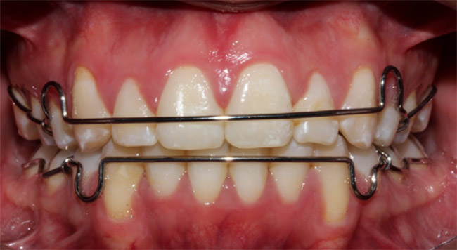 Fig. 21 Intraoral de frente con retenedores
