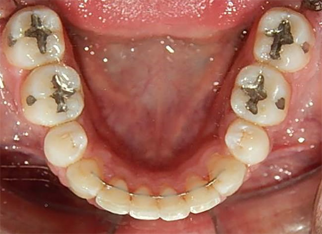 Fig.23 Fijos de 3 a 3 en superior e inferior