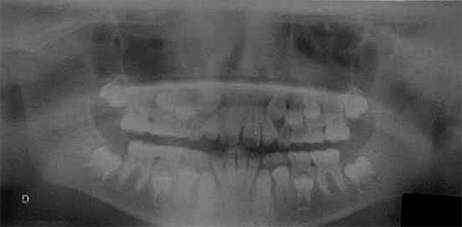 Fig. 3 Radiografía panorámica de inicio