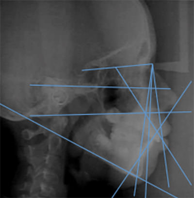 Fig. 4 Radiografía lateral de inicio