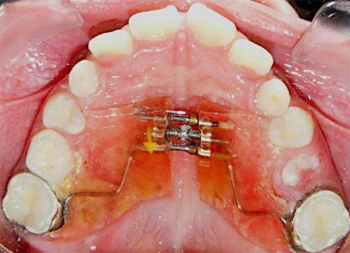 Fig. 12 Oclusal superior