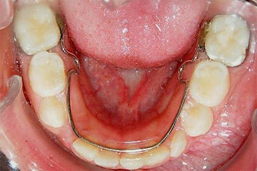 Fig. 13 Oclusal inferior