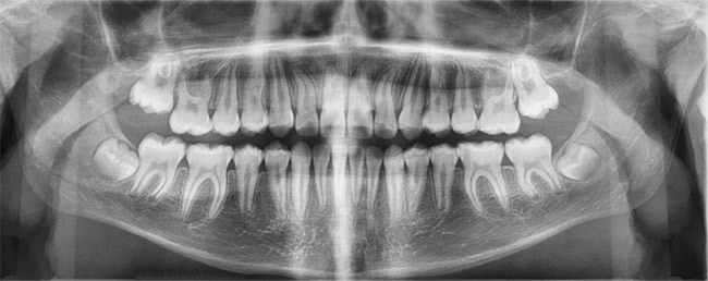 Fig. 16 Radiografía panorámica final