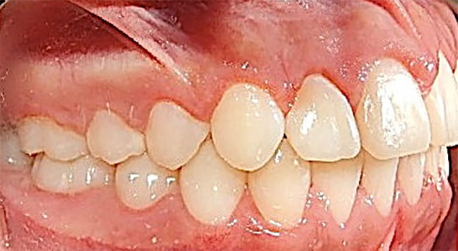 Fig. 19 Lateral derecha final