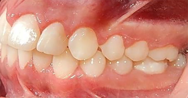 Fig. 20 Lateral izquierda final