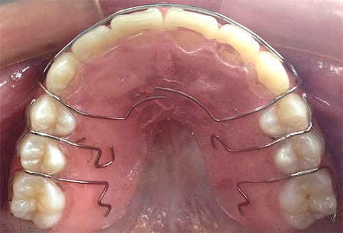 Fig. 21 Retenedor circunferencial superior