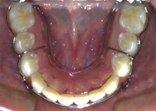 Fig. 22 Circunferencial inferior