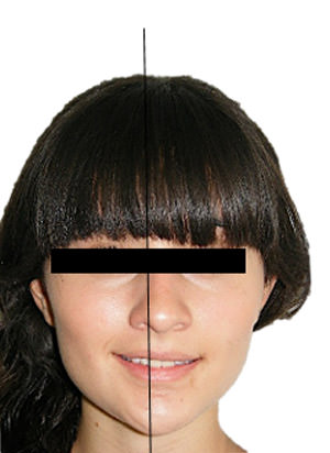 Fig 1 Frente sonrisa