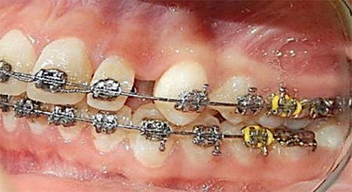 Fig.10 Distalización superior bilateral a partir de la extracción de segundos molares superiores