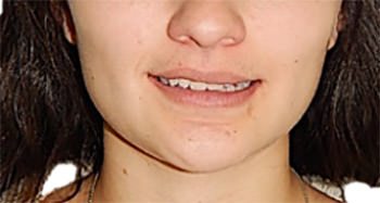 Fig 11 Simetría facial
