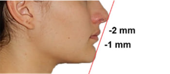 Fig 12 Corrección del perfil labial