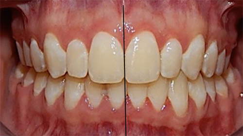 Fig 13 Intrabucal final de frente