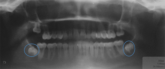 Fig. 16 Rx panorámica final