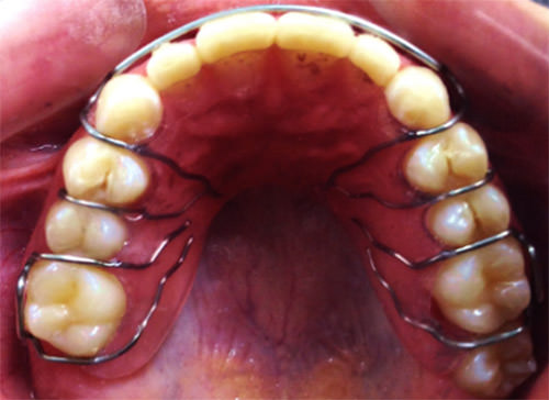 Fig. 17 Retenedor Hawley modificado