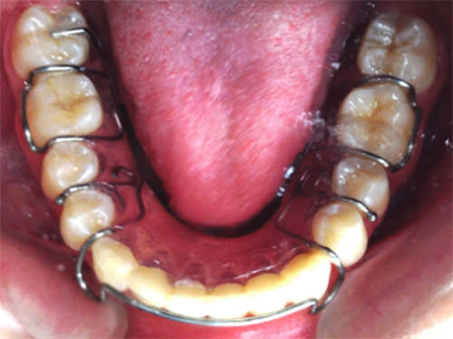Fig. 18 Inferior Hawley