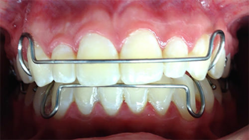 Fig 19 Frente retenedores Hawley