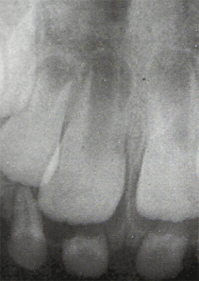 Fig. 4 Radiografía Periapical. Tomado de D' Escriván de Saturno. Ortodoncia en Dentición Mixta.