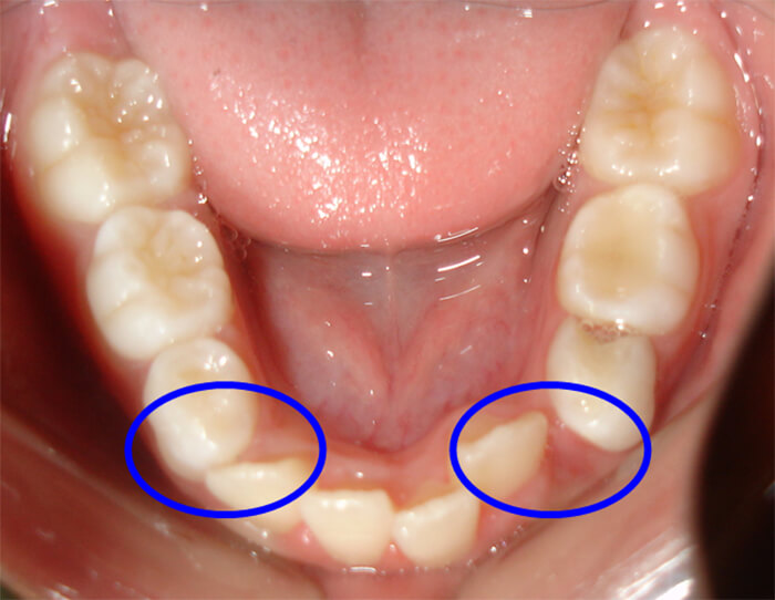 Fig. 6 Pérdida Prematura del 83 y 73 Paciente Clínica Odontopediatria UGMA