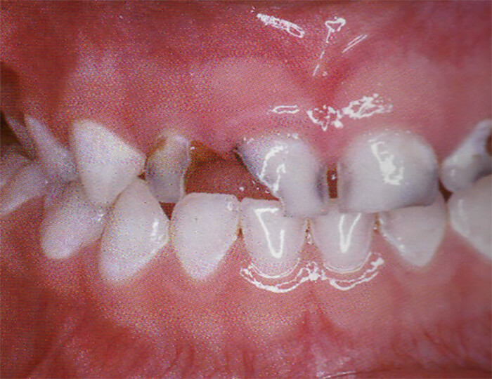 Fig. 8 Presencia de caries en el sector anterior. Tomado de D' Escriván de Saturno. Ortodoncia en Dentición Mixta